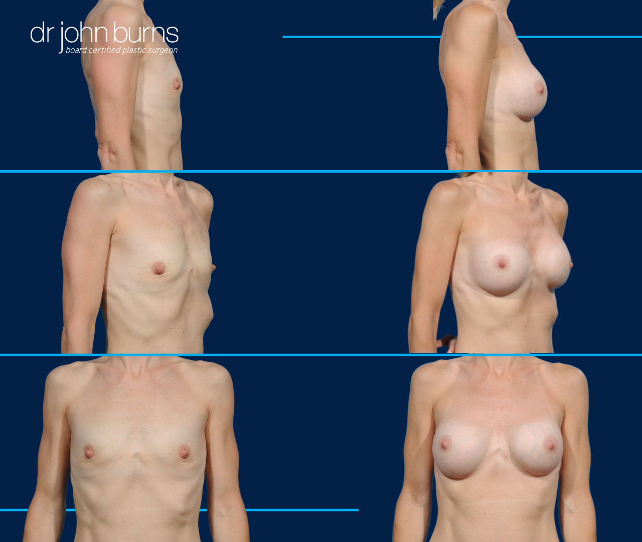 235cc subfascial breast augmentation results by Dr. John Burns