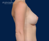 A to C Cup- Mommy Makeover Breast Augmentation- Dr. John Burns