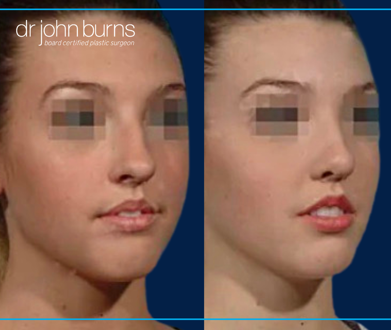 Open Rhinoplasty Results For 20 year old woman by Dr. John Burns
