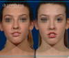 Open Rhinoplasty Results For 20 year old woman by Dr. John Burns