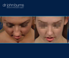 Open Rhinoplasty Results For 20 year old woman by Dr. John Burns