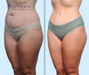 L 45 Degree View | Before & After Mommy Makeover Tummy Tuck by Dallas Plastic Surgeon Dr. John Burns