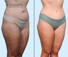 R 45 Degree View | Before & After Mommy Makeover Tummy Tuck by Dallas Plastic Surgeon Dr. John Burns