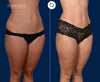 45 Degree View | Before and After Mini Tummy Tuck by Dallas Plastic Surgeon Dr. John Burns