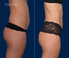 Profile View | Before and After Mini Tummy Tuck by Dallas Plastic Surgeon Dr. John Burns
