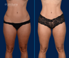 Anterior View | Before and After Mini Tummy Tuck by Dallas Plastic Surgeon Dr. John Burns