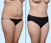45 Degree View | Before and After Tummy Tuck with Lipo 360 by Dallas Plastic Surgeon Dr. John Burns