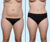 Anterior View | Before and After Tummy Tuck with Lipo 360 by Dallas Plastic Surgeon Dr. John Burns