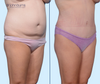 45 Degree View | Before and After Standard Tummy Tuck with Lipo 360 by Dallas Plastic Surgeon Dr. John Burns