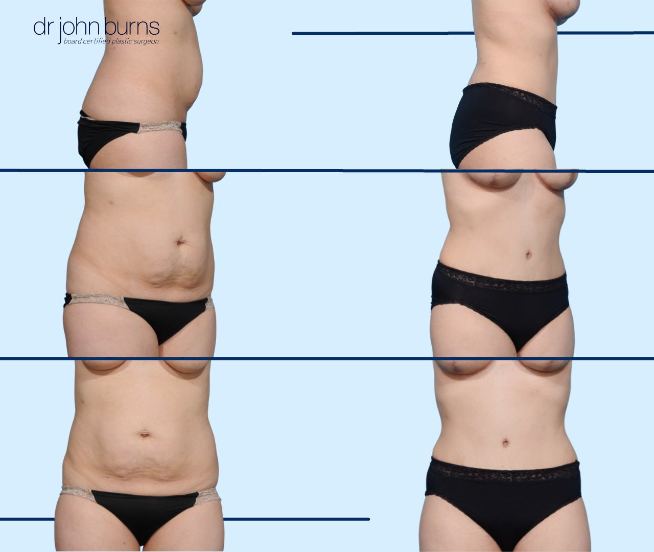 Body Contouring Fort Worth