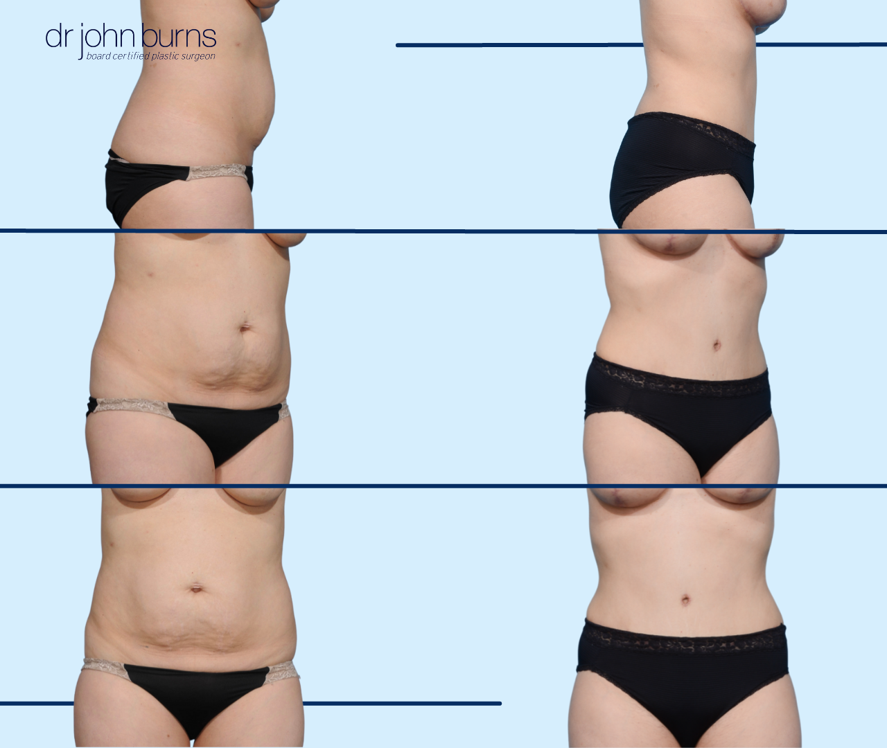 Dallas Mommy Makeover- Tummy Tuck & Liposuction by Dr. John Burns – Dr John  Burns