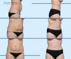 Before and After Tummy Tuck with Lipo 360 by Dallas Plastic Surgeon Dr. John Burns