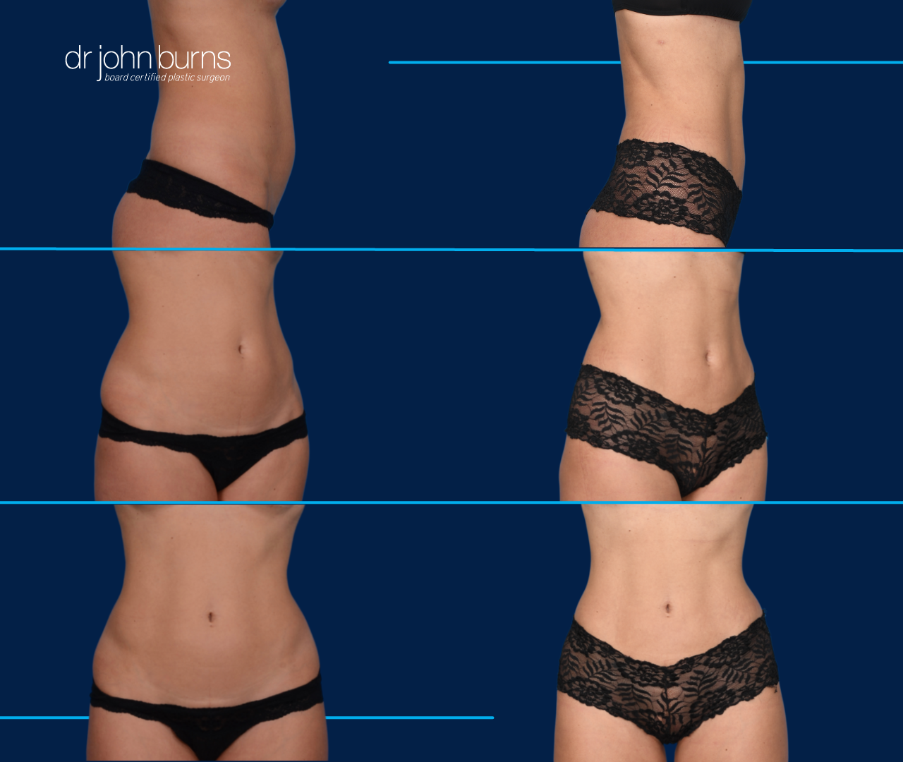 Before and After Mini Tummy Tuck by Dallas Plastic Surgeon Dr. John Burns
