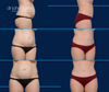 Before and After Tummy Tuck by Dallas Mommy Makeover Expert, Dr. John Burns