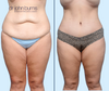 Anterior View | Before & After Extended Tummy Tuck Mommy Makeover by Dallas Plastic Surgeon Dr. John Burns