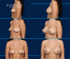 Before and After Mommy Makeover Breast Augmentation by Dr. John Burns