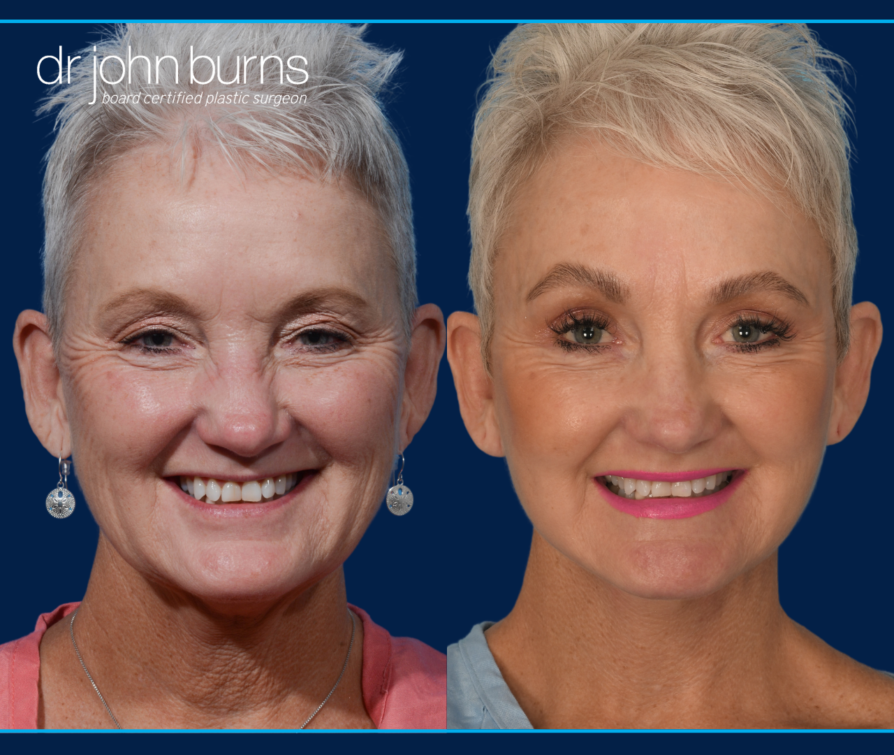 Before and After Facelift + Neck lift with Eyelid lift by Dr. John Burns