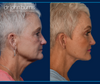 Profile View of Before and After Facelift + Neck lift with Eyelid lift by Dr. John Burns