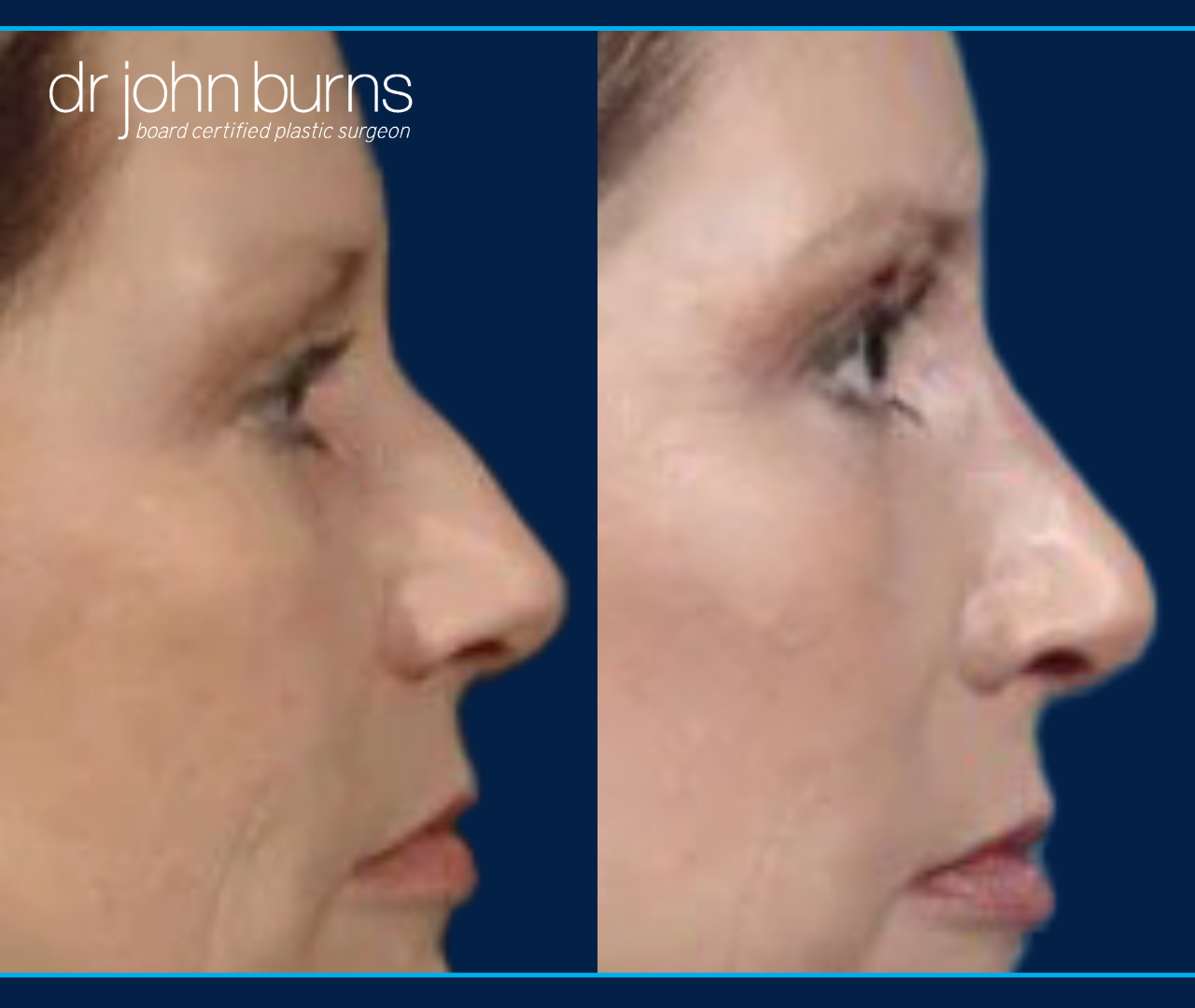 Right profile view of closed rhinoplasty results for dorsal hump correction by Dr. John Burns