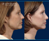 Profile View, Mini Facelift with Rhinoplasty by Dr. John Burns