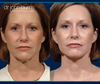 Mini Facelift with Rhinoplasty by Dr. John Burns