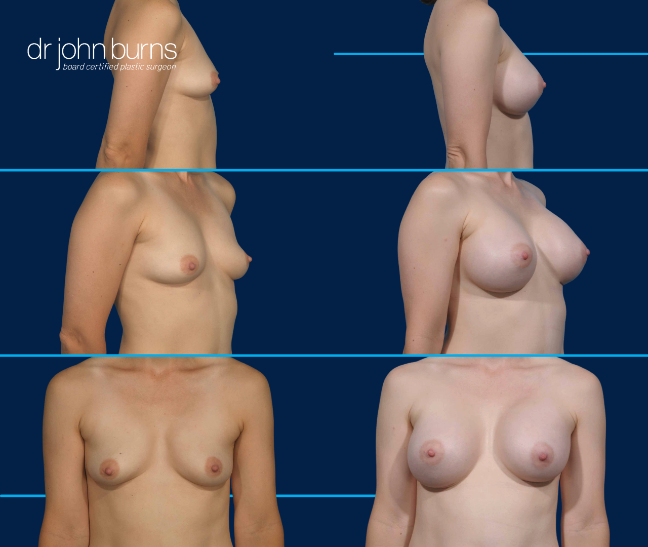 Before and After Breast Implants by Dr. John Burns