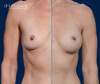 Subfascial Breast Augmentation results by Dr. John Burns