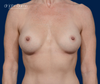 Subfascial Breast Augmentation results by Dr. John Burns