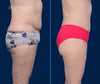 Profile View | Revision Tummy Tuck | Before and After | By Dallas Plastic Surgeon Dr. John Burns