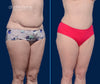 45 Degree View | Revision Tummy Tuck | Before and After | By Dallas Plastic Surgeon Dr. John Burns
