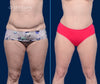 Anterior View | Revision Tummy Tuck | Before and After | By Dallas Plastic Surgeon Dr. John Burns