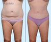Anterior View | Before and After Standard Tummy Tuck with Lipo 360 by Dallas Plastic Surgeon Dr. John Burns
