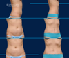 Case 4-Mini Tummy Tuck Before and After