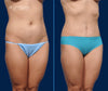 45 Degree View | Before and After Mini Tummy Tuck by Dallas Plastic Surgeon, Dr. John Burns