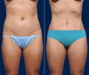 Anterior View | Before and After Mini Tummy Tuck by Dallas Plastic Surgeon, Dr. John Burns