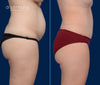 Profile View | Before and After Tummy Tuck by Dallas Mommy Makeover Expert, Dr. John Burns