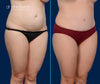 45 Degree View | Before and After Tummy Tuck by Dallas Mommy Makeover Expert, Dr. John Burns