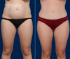 Anterior View | Before and After Tummy Tuck by Dallas Mommy Makeover Expert, Dr. John Burns