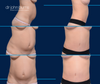 Before & After Tummy Tuck with Lipo 360 by Dallas Plastic Surgeon, Dr. John Burns