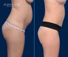Profile View | Before & After Tummy Tuck with Lipo 360 by Dallas Plastic Surgeon, Dr. John Burns