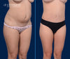45 Degree View | Before & After Tummy Tuck with Lipo 360 by Dallas Plastic Surgeon, Dr. John Burns