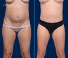Anterior View | Before & After Tummy Tuck with Lipo 360 by Dallas Plastic Surgeon, Dr. John Burns