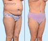 45 Degree View | Before & After Corset Tummy Tuck by Dallas Plastic Surgeon, Dr. John Burns