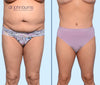 Anterior View | Before & After Corset Tummy Tuck by Dallas Plastic Surgeon, Dr. John Burns