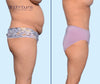 Profile View | Before & After Corset Tummy Tuck by Dallas Plastic Surgeon, Dr. John Burns
